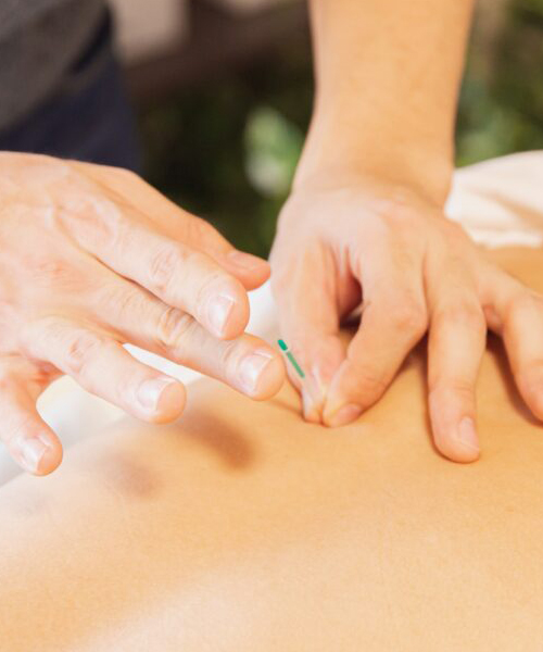 Acupuntura